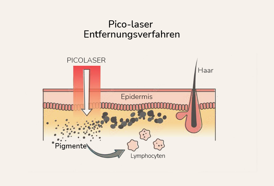 tattooentfernung dank picolaser verfahern erklärt