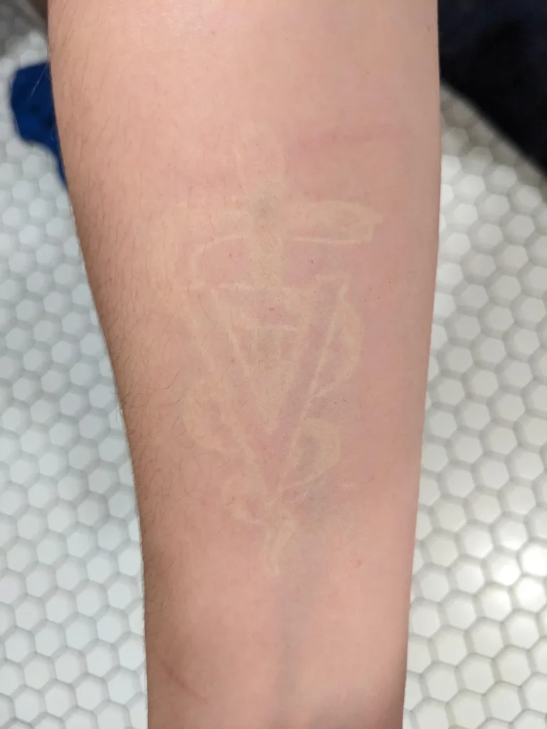 white tattoo ink turns yellowish over time after healing, weisse tinte tattoos können wie narben aussehen nach heilung, heilungprozess schwierieger bein weisse tinte. sieht wiess tattoo gut aus, ist weiss tattoo eine gute idee