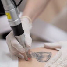 Close-up der Pico-Laser Behandlung zur Tattooentfernung – präzise Lasertechnologie