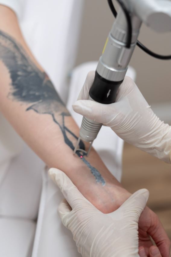 Close-up der Pico-Laser Behandlung zur Tattooentfernung – präzise Lasertechnologie