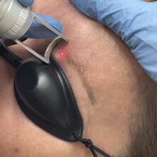 Close-up einer Picolaser-Behandlung zur Entfernung von Permanent Make-up an den Augenbrauen im Studio Amulett-Tattoo in Zürich, 2026.